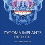 Zygoma implants : step by step