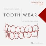 Tooth Wear : Interceptive treatment approach with minimally invasive protocols