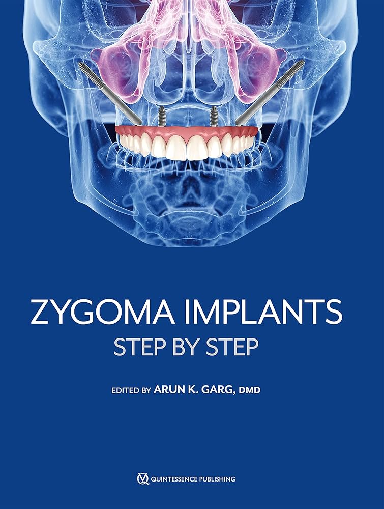 Zygoma implants step by step